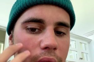 Justin Bieber bị liệt nửa mặt do nhiễm virus hiếm